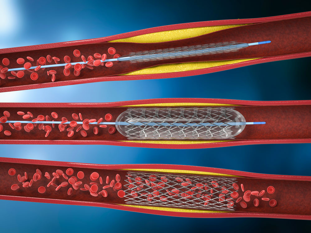 Koroner Anjiyoplasti (Balon) – Stent Tedavisi