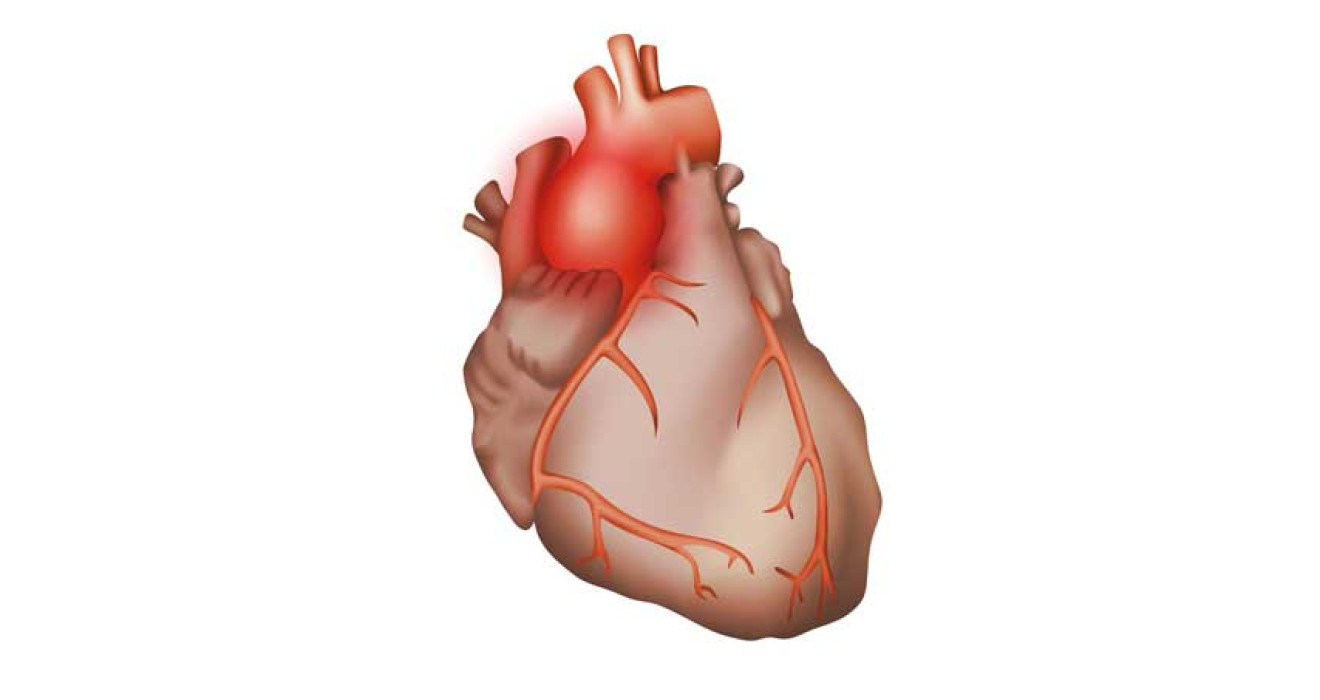 Aortic Aneurysm (Enlargement)