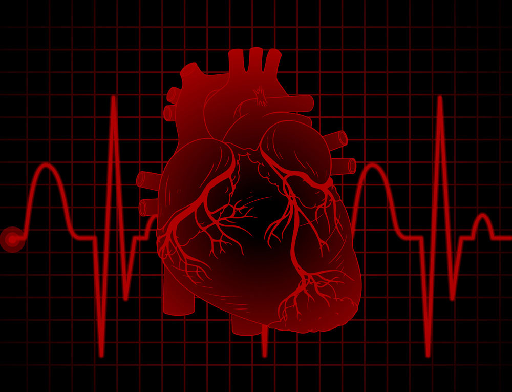 atrial fibrillation