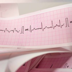 Atriyal Fibrilasyon: Nedir, Nasıl Anlaşılır, Tedavisi Nasıl Yapılır?