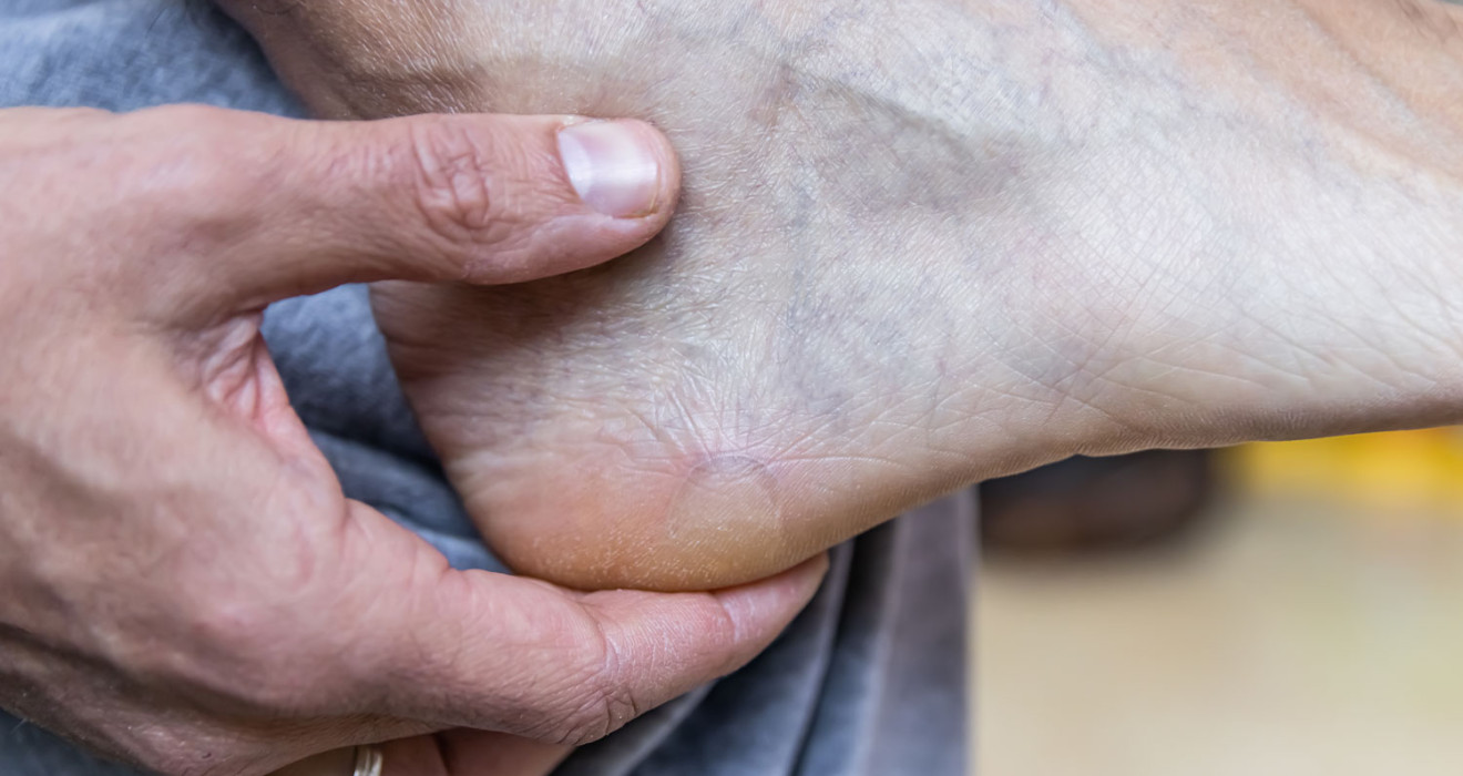 Peripheral Arterial Disease