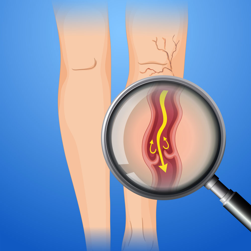 8 Golden Rules to Reduce Leg Edema