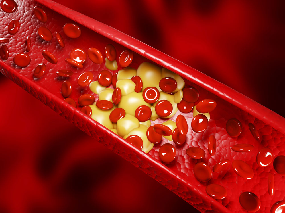 Coronary artery disease treatment