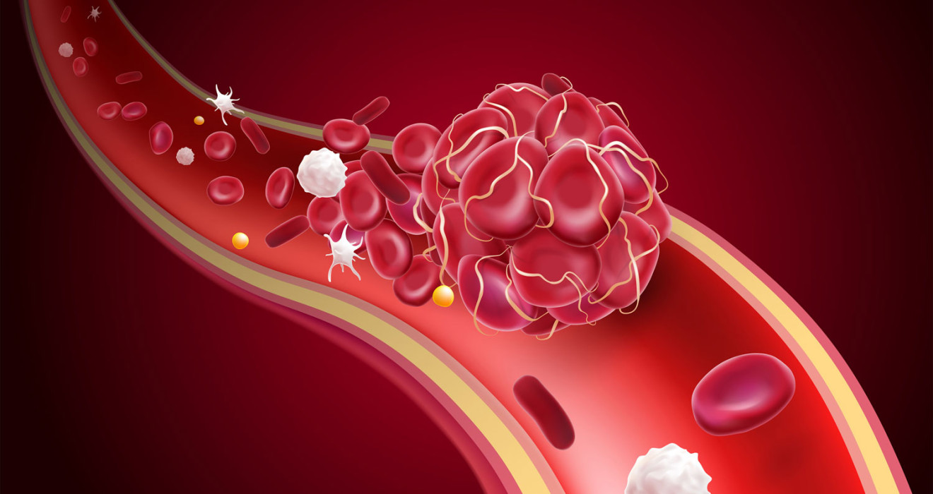 Atherosclerosis