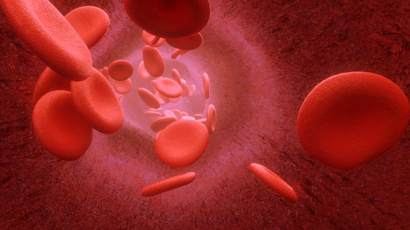 Atherosclerosis