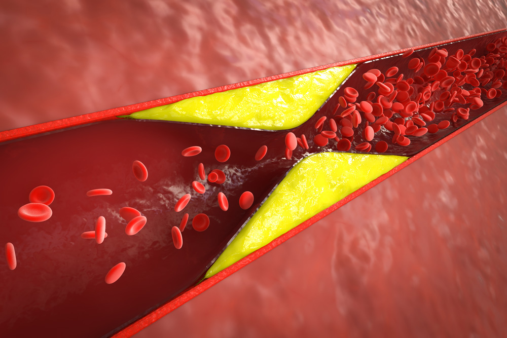 High Cholesterol Treatment