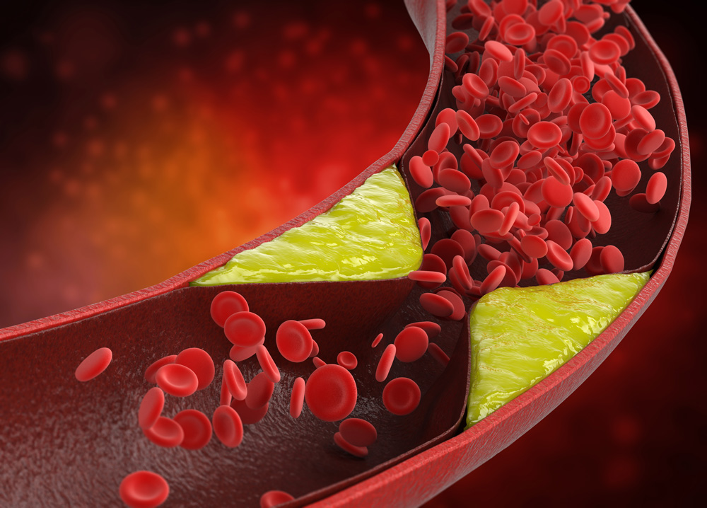 Hyperlipidemia (High Cholesterol)