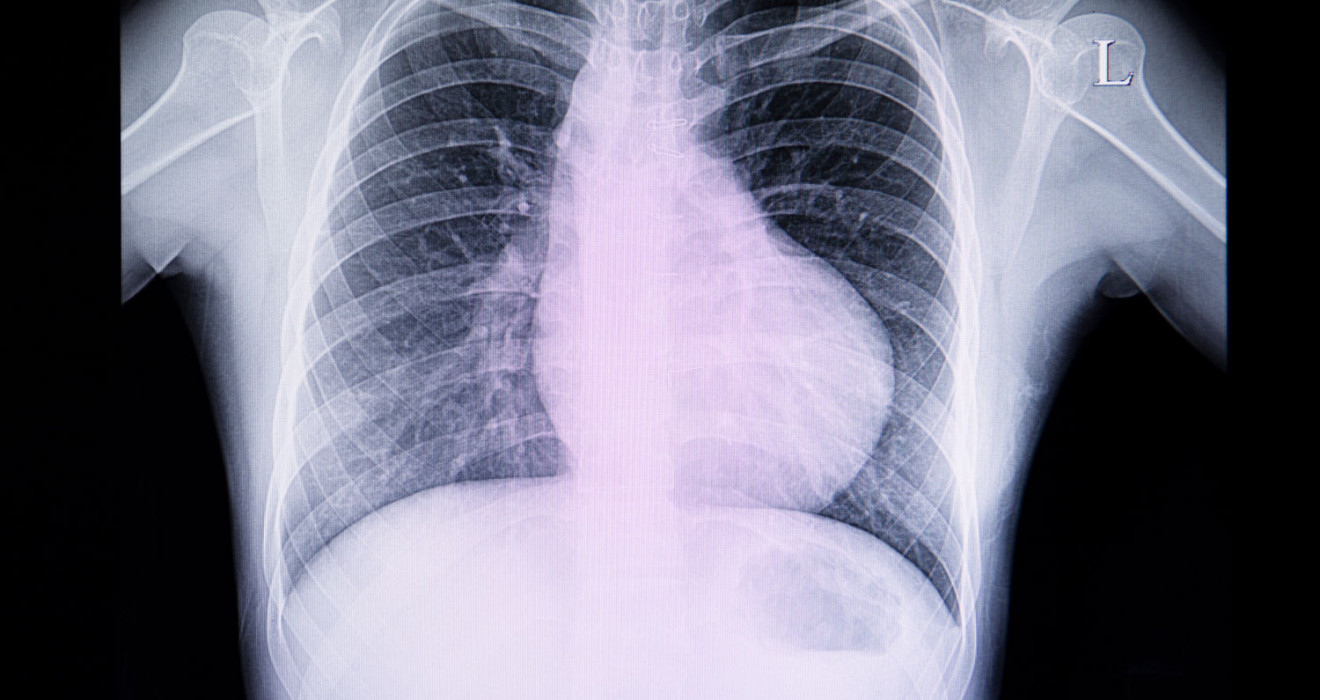 Cardiac Dilatation Treatment