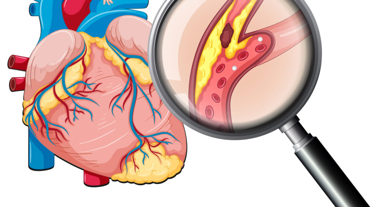 High Cholesterol Treatment