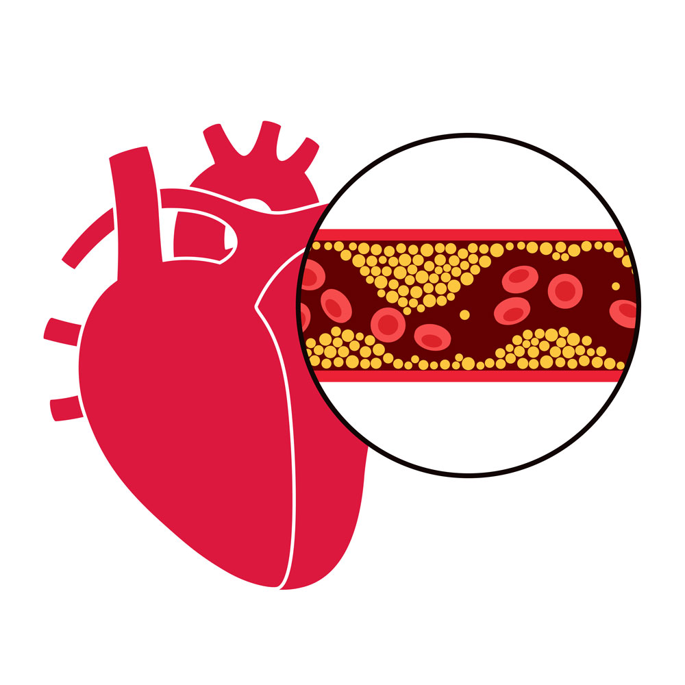 Coronary Artery Disease