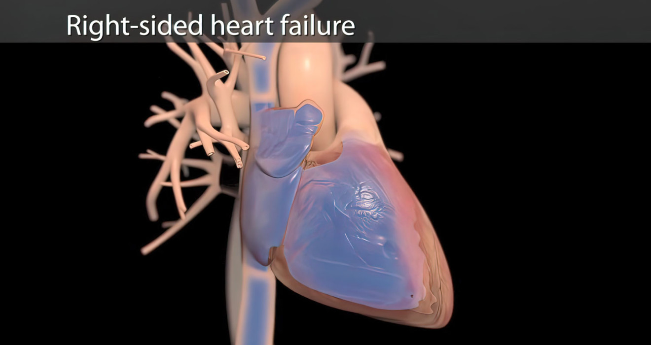 Right Heart Failure
