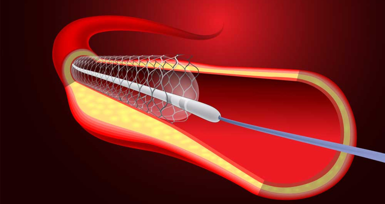 Stent: What Is It, Why Is It Placed, How Is It Placed?