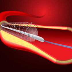 Stent: Nedir, Neden Takılır, Nasıl Takılır?